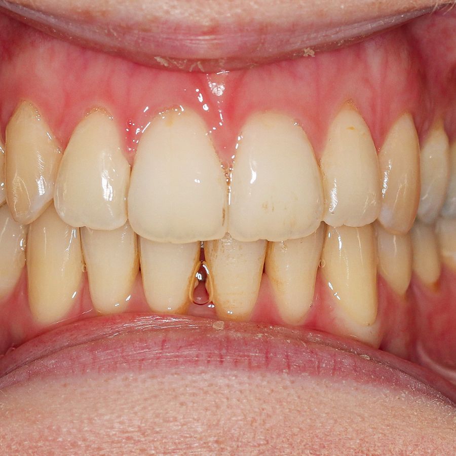 teeth cleaning before